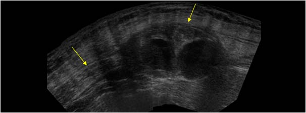 Rectus sheath hematoma and normal rectus transverse extended field of view