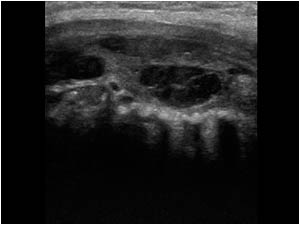 Isthmus with sarcomatoid carcinoma longitudinal