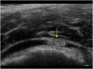 Effusion and calcification in the bursa transverse