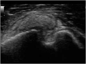 Calcifications anterior of the biceps tendon transverse