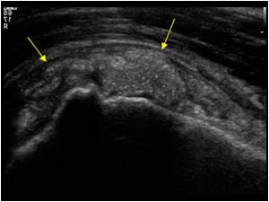 Calcific tendinitis with calcifications penetrating in the bursa