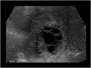 Pyogenic liver abscesses