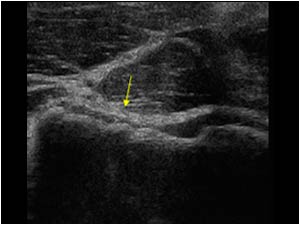 Thinning of the humeral cartilage