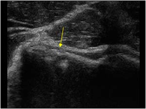 Thinning of the humeral cartilage