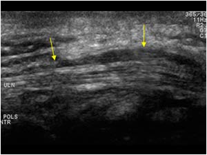 Thickened ulnar nerve with perineural hypodensity longitudinal