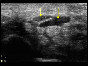 Median nerve and anomalous flexor digitorum superficialis muscle of the index finger transverse