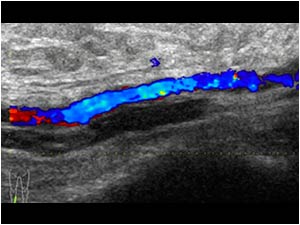 Thrombus in the tibial vein and tibial artery longitudinal
