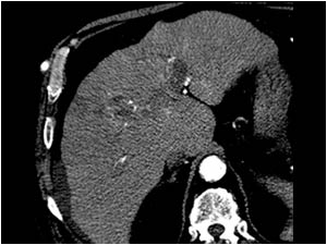 Case of the month April 2008: Tumor thrombus in the portal vein