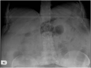 Case of the month October 2008: Hernia
