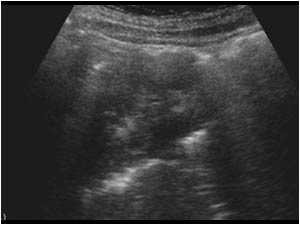 Right kidney obscured by retroperitoneal air longitudinal