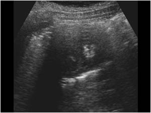 Right kidney obscured by retroperitoneal air transverse