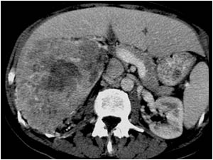 Case of the month January 2008: Renal cell carcinoma with tumor thrombus in the renal vein