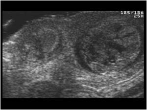 This transverse view shows a swollen inhomogeneous left testicle and an abnormal small inhomogeneous right testicle with calcifications in the tunica vaginalis.