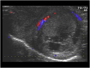 The color doppler shows only vascularization in the scrotal wall, but not in the right and left testicle.