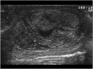 Longitudinal view of the left testicle with an inhomogeneous aspect caused by necrosis. Both testicles have the characteristics of a chronic testicular torsion.

The testicular torsion takes place in utero. When the patient is born it is already too lat