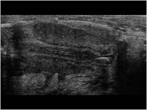 Longitudinal image showing a massive thickened appendix with a fecolith at the tip.