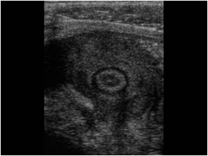 Transverse image showing the same massive thickened appendix.