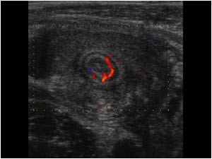 Transverse image with color doppler showing vascularization of the appendiceal wall.