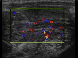 Longitudinal image with color doppler showing vascularization of the appendiceal wall.