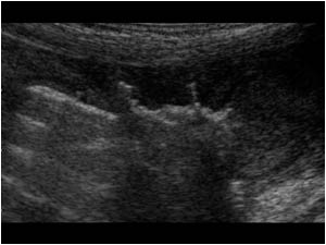 Longitudinal image of the thickened cecal wall with thumb printing.

Because this was not a normal presentation of an acute appendicitis the patient was not operated, but instead a biopsy was performed which showed granulomas highly suggestive for Crohn