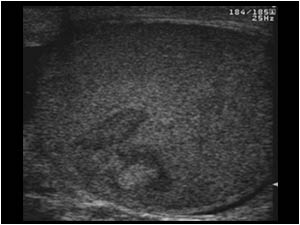 This lobulated testicular lesion in a 32 year old patient with mixed echogenicity, without vascularization, appeared to be a hemorrhagic chronic inflammation.

However testicular lesions, especially when they are vascularized, should always be considere