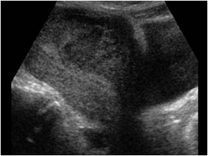 Longitudinal image of the hypoechoic lesion in the uterus that could be mistaken for a uterine fibroid.
