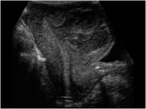 This longitudinal image shows a different appearance of the lesion. The lesion expands from the endometrial cavity to the myometrium with an interruption of the endometrial lining.