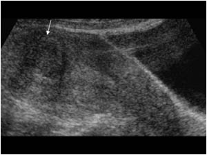 This longitudinal image shows a hypoechoic submucosal fibroid that can also be a cause of vaginal bleeding.
