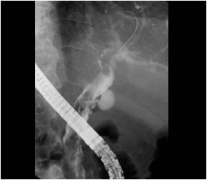 An ERCP shows filling defects which proved to be bloodclots. The bloodclots cause a moderate bile duct obstruction. The patient had hemobilia. Hemobilia can have several causes such as trauma or tumors. In this case no cause for the hemobilia was found an
