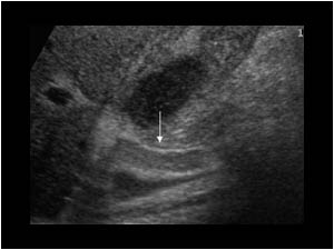 This image shows reflective material in the common bile duct caused by thickened bile.