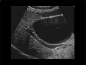 This image shows the cystic mass anterior of the portal vein.