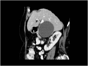 CT scan of the same hepatic cyst.