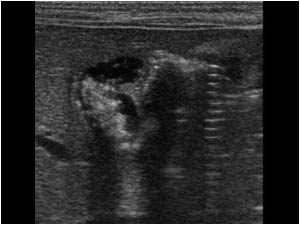 There is an abnormal gallbladder filled with sludge and small stones causing acoustic shadowing.

Sludge and stones can be found in neonates that are on parenteral nutrition. This patient was not on parenteral nutrition.

Also reflective material in t