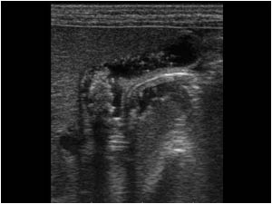 An ultrasound examination performed 2 days later revealed no change.

Because the baby was treated with an antibiotic from the cephalosporin group (Claforan = Cefotaxime) a relation between the medication and the material in the gallbladder was suspecte