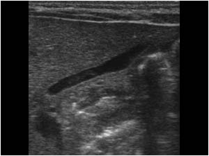 Abnormal gallbladder in a neonate