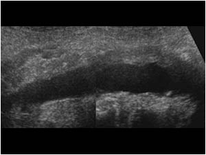 Longitudinal image showing a mass ventral of the distal abdominal aorta and a normal proximal aorta.