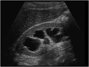 Longitudinal image of the right kidney with a dilatated collecting system.
