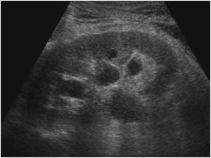 Longitudinal image of the left kidney with a dilatated collecting system.