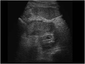 Transverse image of the left kidney with a perirenal effusion caused by a fornix rupture.