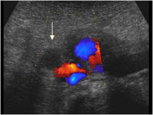 Transverse color doppler image showing a medial displaced and dilatated right ureter ventral of the vena cava and next to the aortic mass (arrow).
