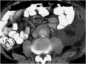 CT image showing the mass around the aorta.