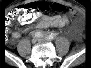 CT image showing the mass around the proximal right and left common iliac artery.