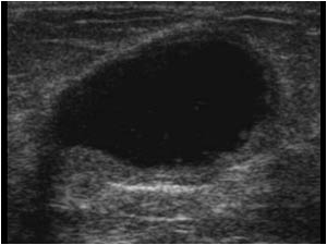 Longitudinal image of a thick walled cyst with slightly irregular contour (left side of the image).