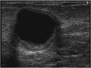 Transverse image of the same cyst.
