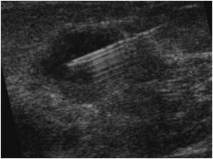An ultrasound guided puncture of the cyst was performed. The fluid that was aspirated was hemorrhagic. The patient was relieved because the lump had disappeared.