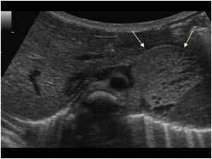 Transverse image of the upper abdomen with an inhomogeneous mass with small cystic areas in the left upper abdomen.