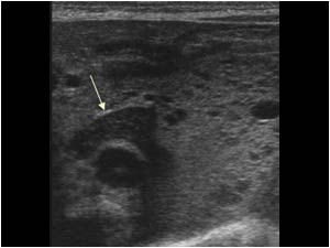 Transverse image of the left adrenal showing the relation to the mass.