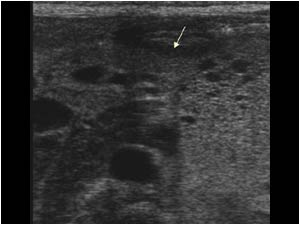 Transverse image of the upper abdomen showing the close relationship of the lesion to the pancreatic tail.
