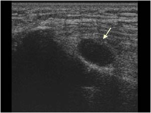 Transverse image of the cystic lesion shows an oval lesion in close contact to the fibular head.