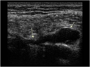 There is not only a close relation between the cystic lesion and the peroneal nerve, but also to the tibiofibular joint space (proximal arrow).